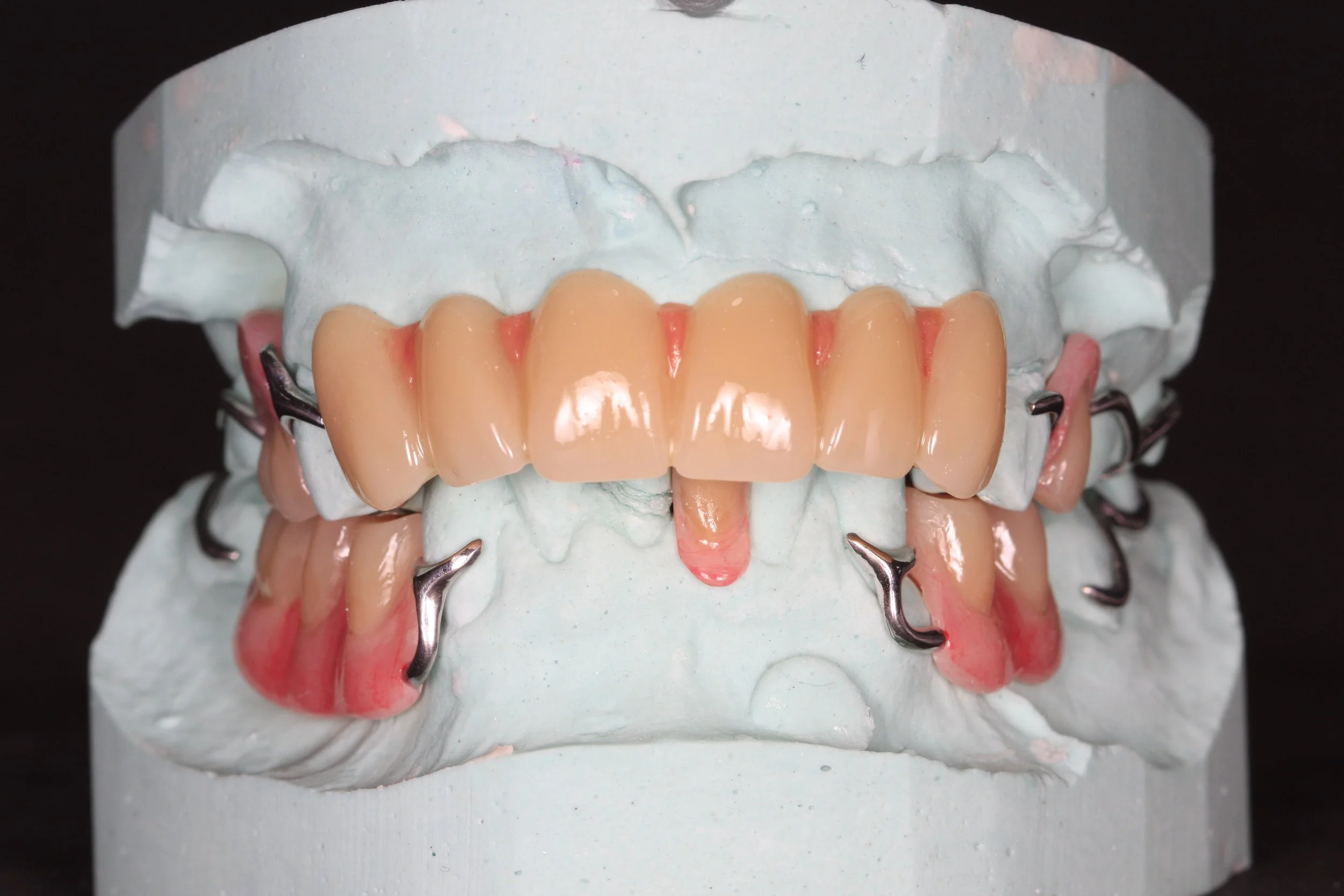 Partial denture with Characterization Technique
