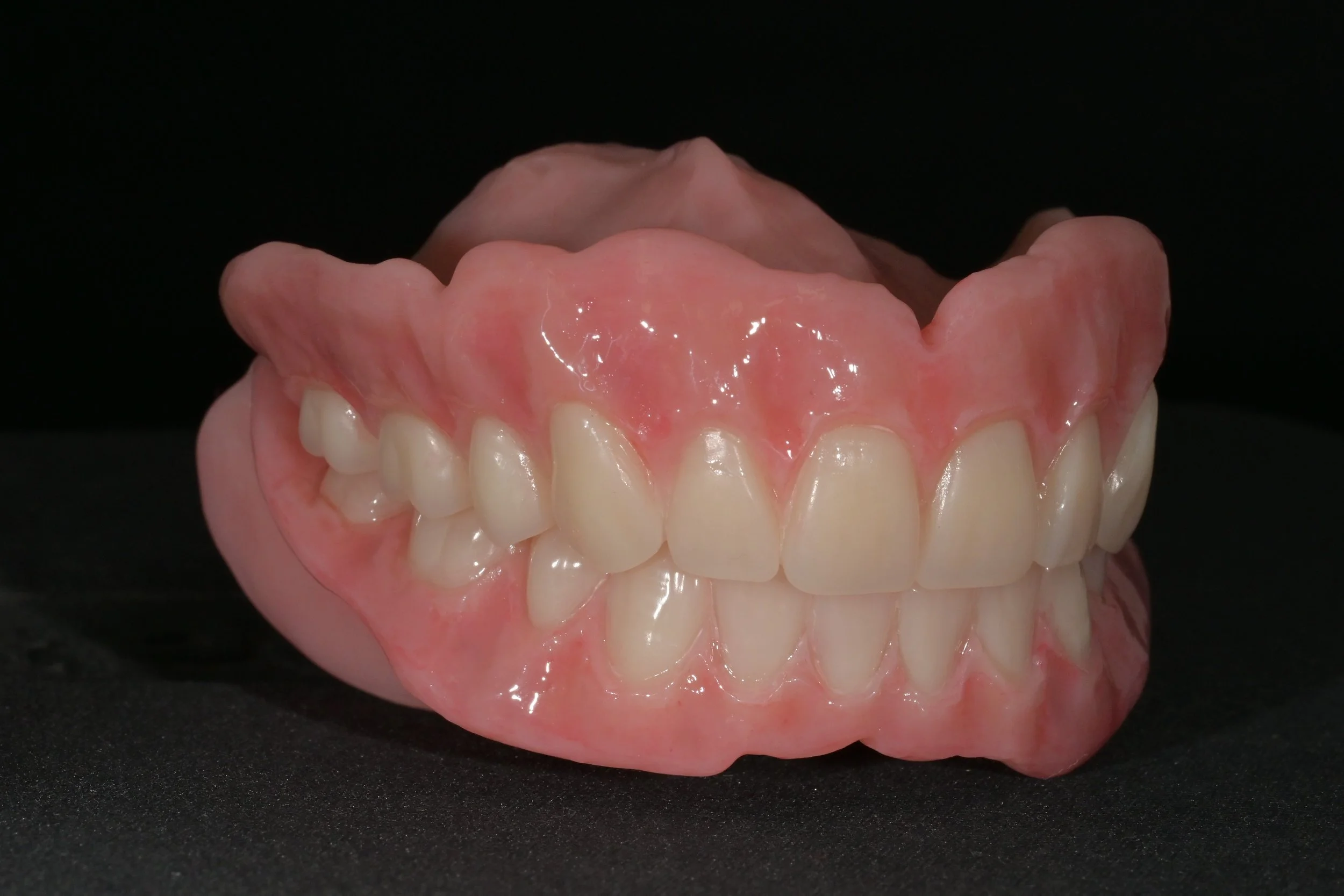 Full denture with Ivoclar phonares and nexco finish1
