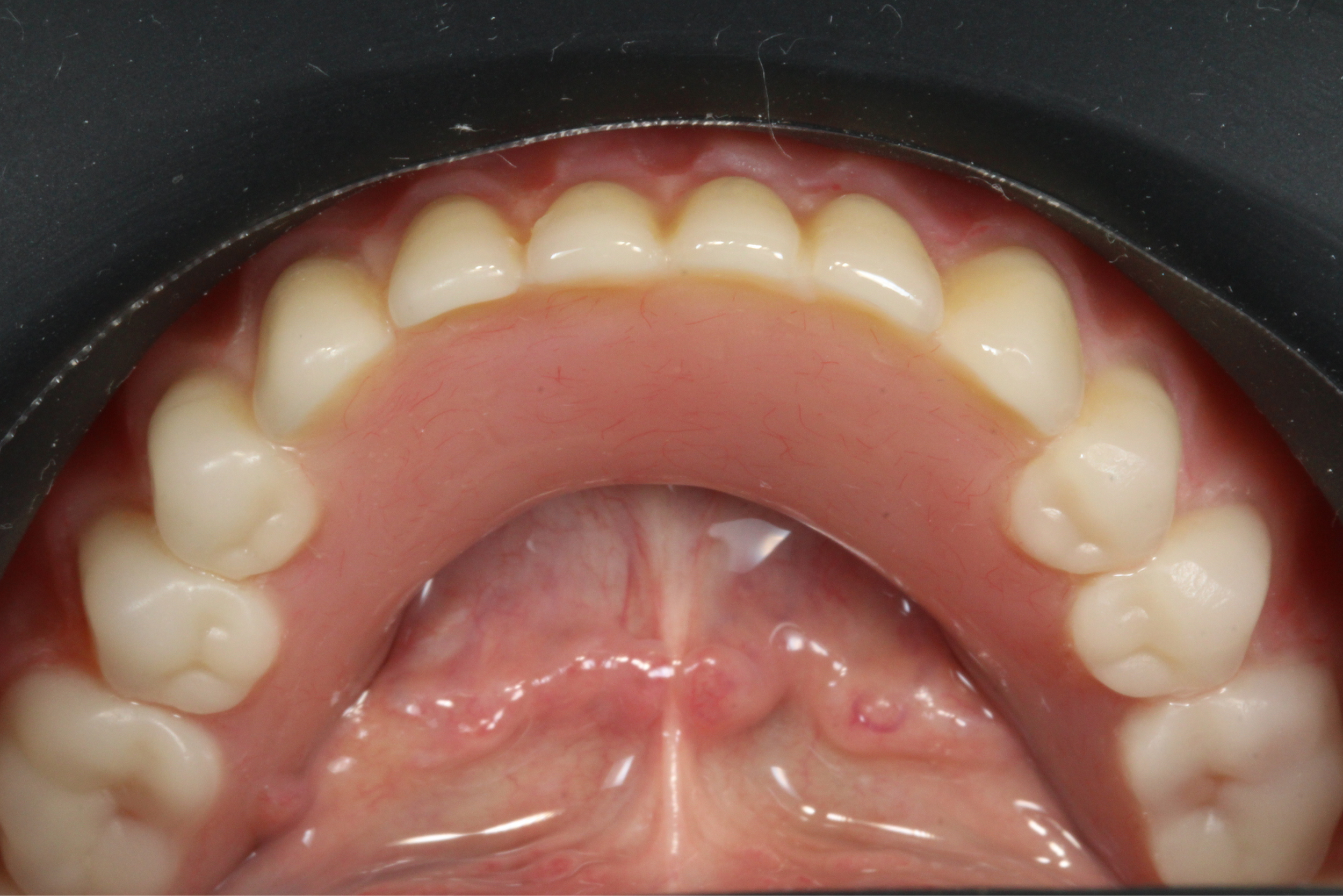 Straumann Crealock on lower overdenture