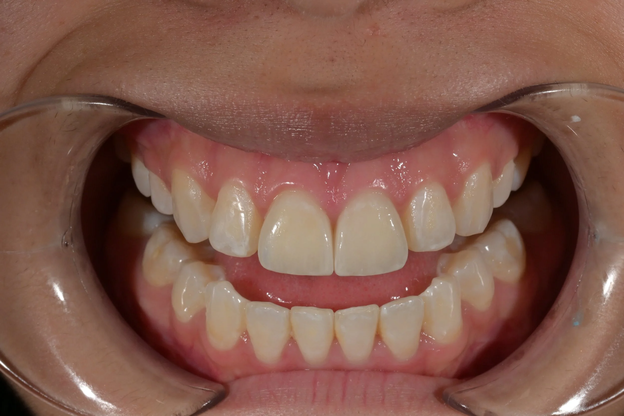Close-up of a child's open mouth with dental retractor showing teeth and gums.