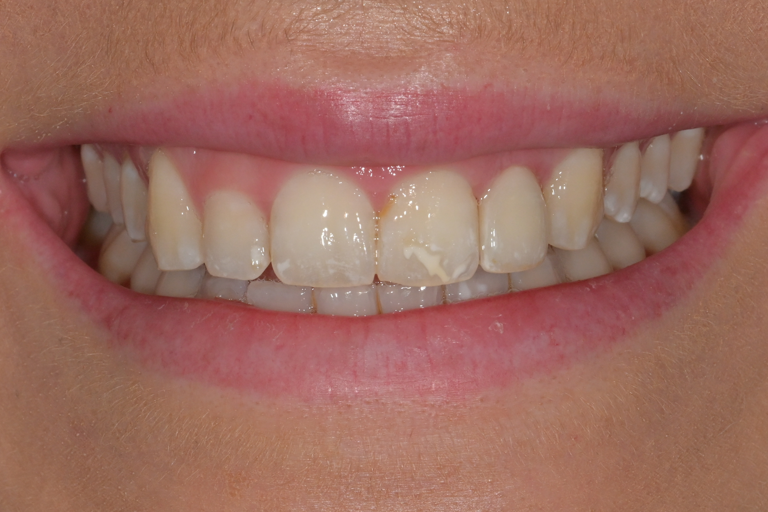 Ivoclar emax on layered emax ceram on #22