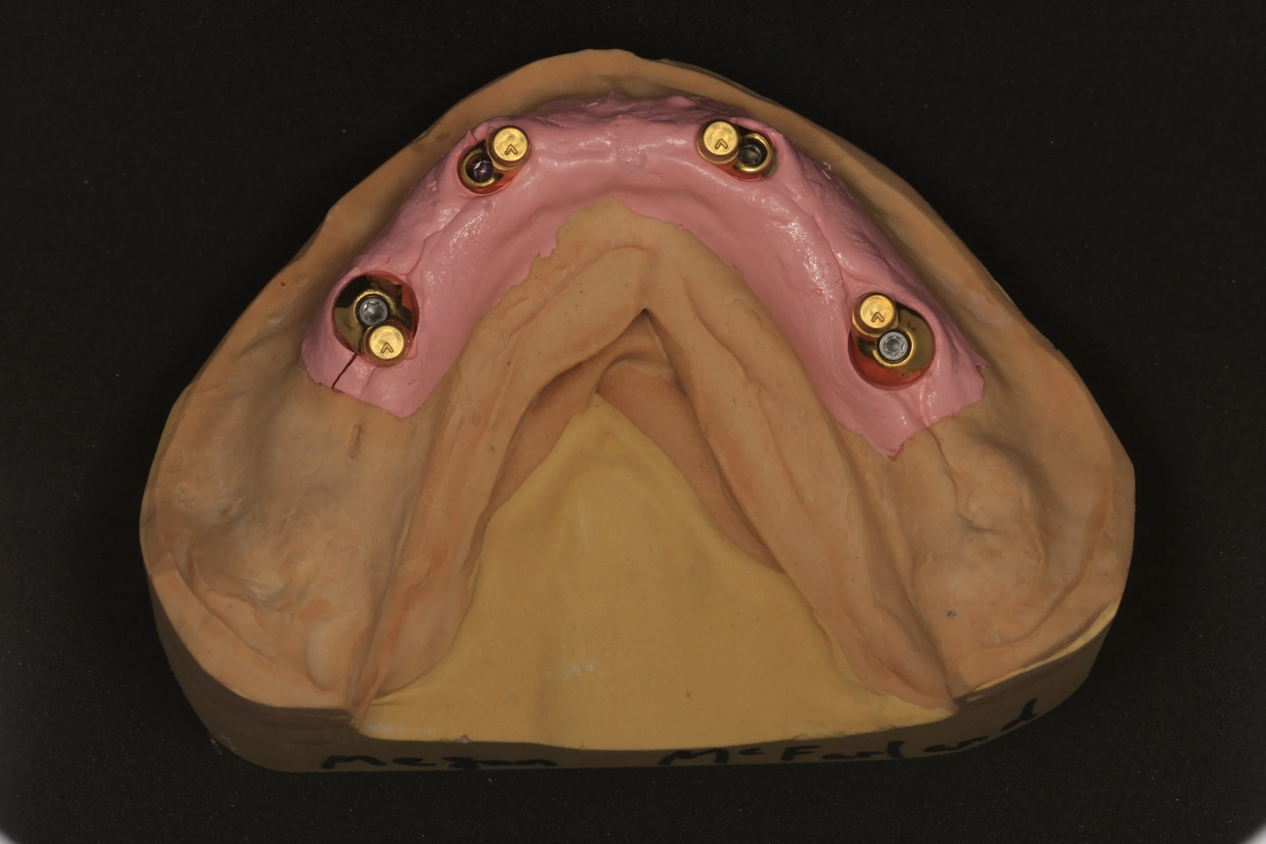 Straumann crealock custom abutments