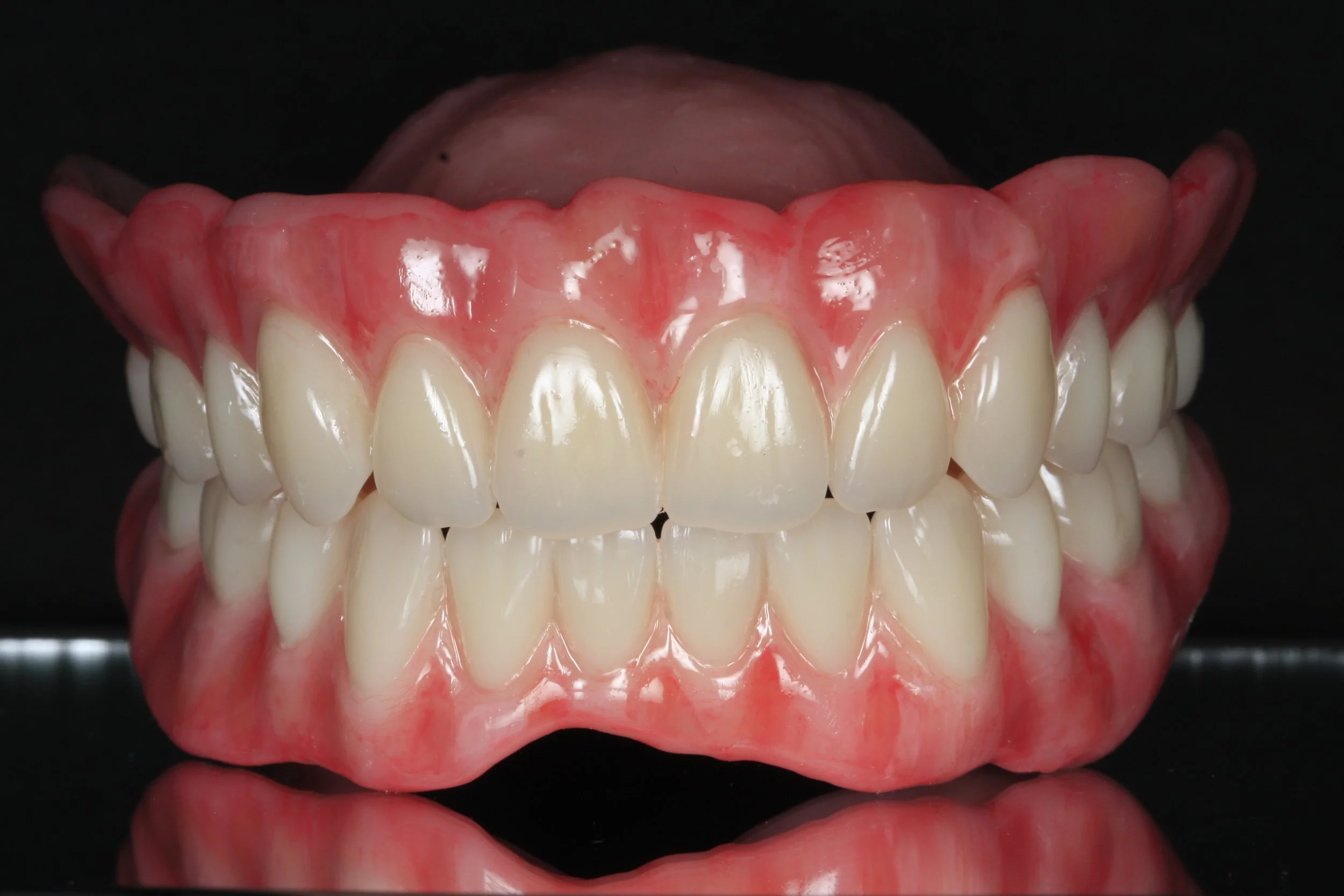 Full denture with Ivoclar phonares and nexco finish