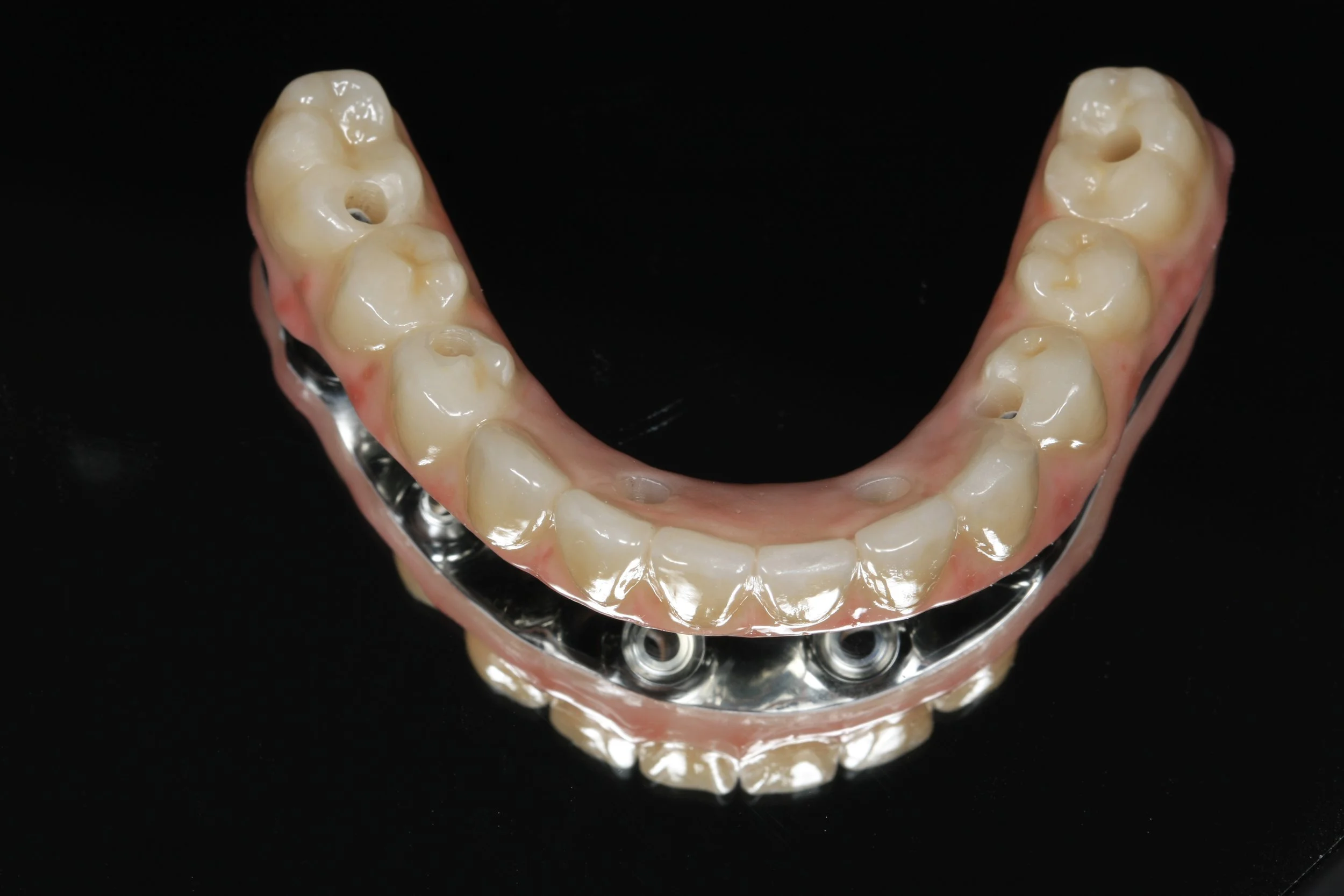 Osteon nexus titanium bar and zirconia finish