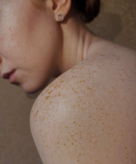 When Stress Shows Up on Your Skin: Understanding Stress-Induced Shingles and Skin Issues