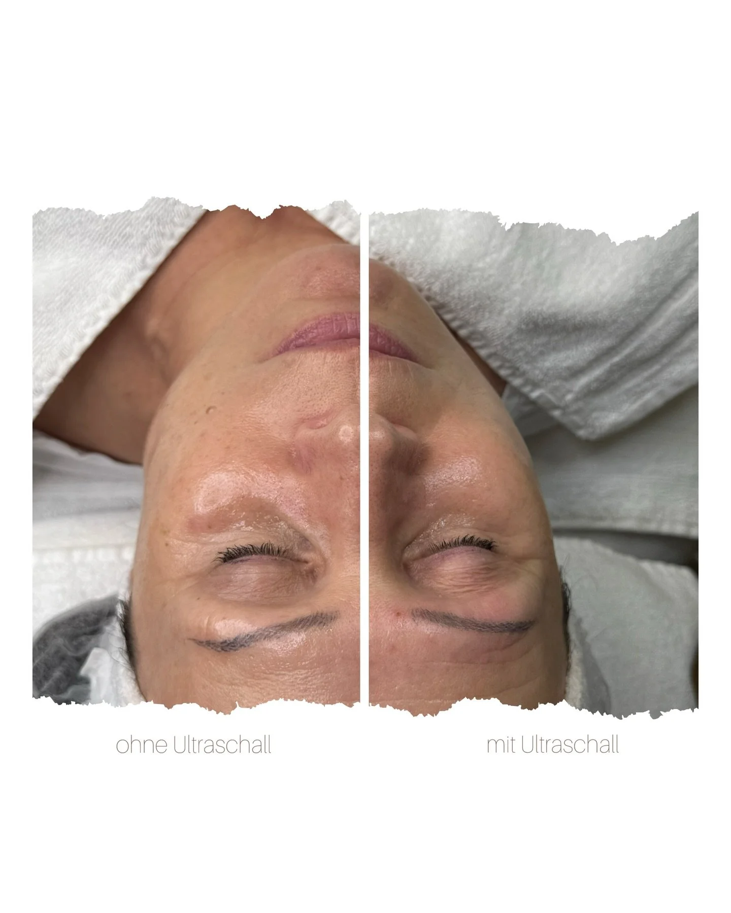 Ein Blick. Zwei Seiten.
Rechts mit Ultraschall behandelt &ndash; links unbehandelt.
Der Unterschied? Sichtbar. Sp&uuml;rbar. Echt.

#ultraschall #HighTechTreatment
#SichtbareErgebnisse #SkinTightening #fypageシ゚