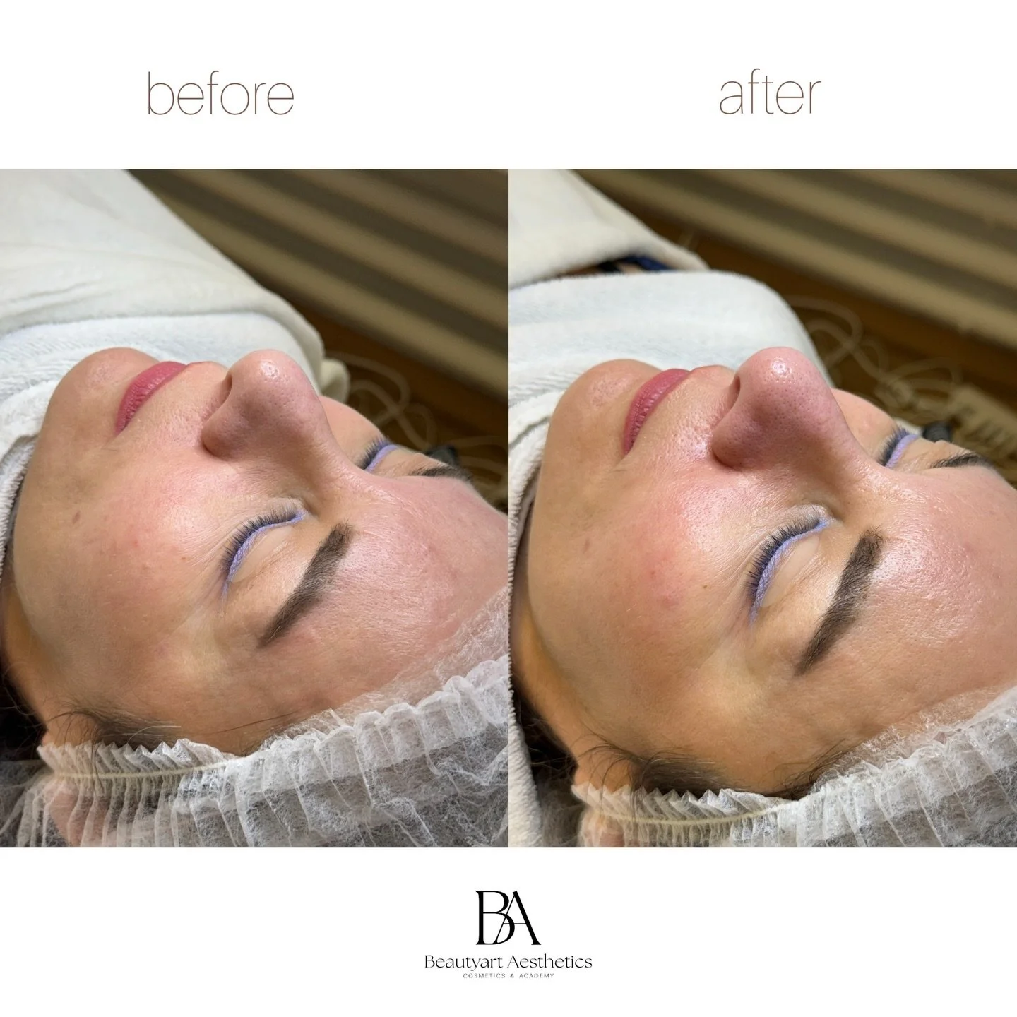 Before ➝ After ✨

#beforeafter #glowup #skincaregoals #hautpflege #facialtreatment