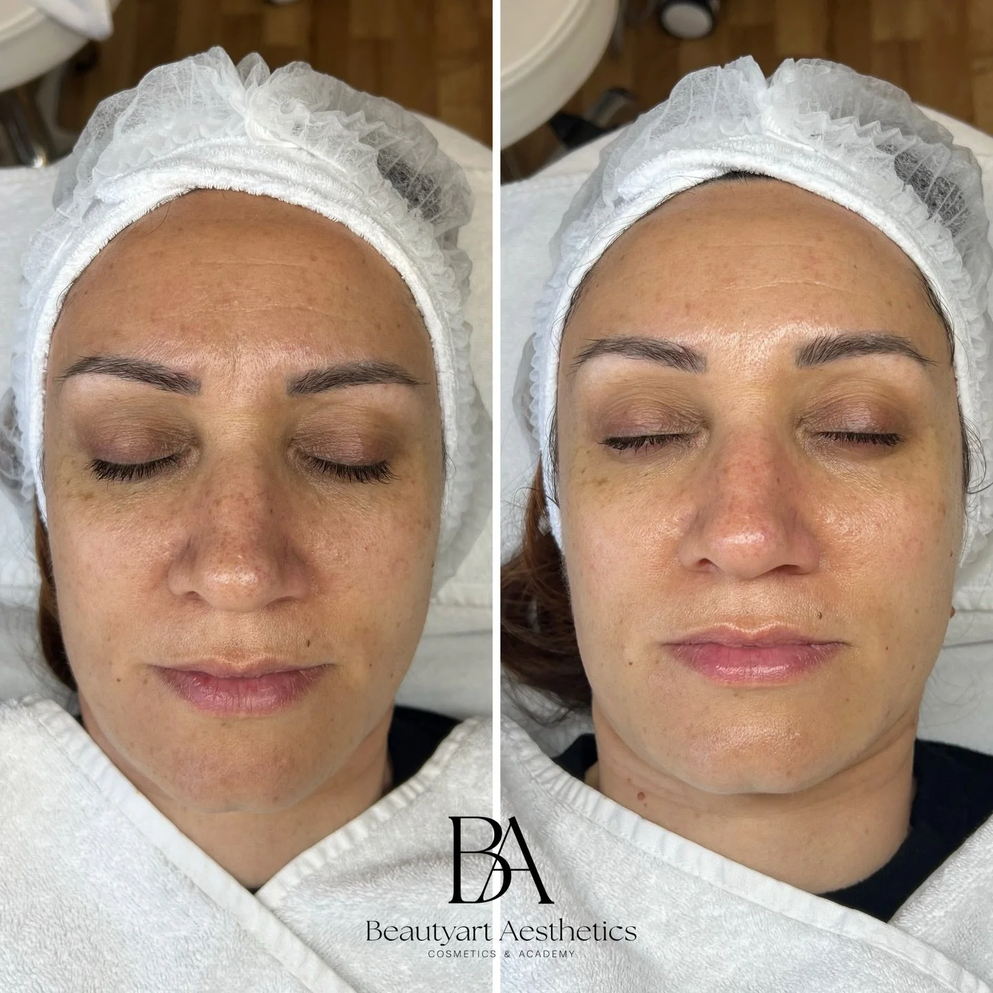 Schon direkt nach unserer Lifting Luxe Behandlung sichtbar: mehr Frische, straffere Konturen und ein nat&uuml;rlicher Glow &ndash; ganz ohne Ausfallzeit.

#liftingfacial #VorherNachher #BeautyTransformation #SkinGlow #aestheticresults
