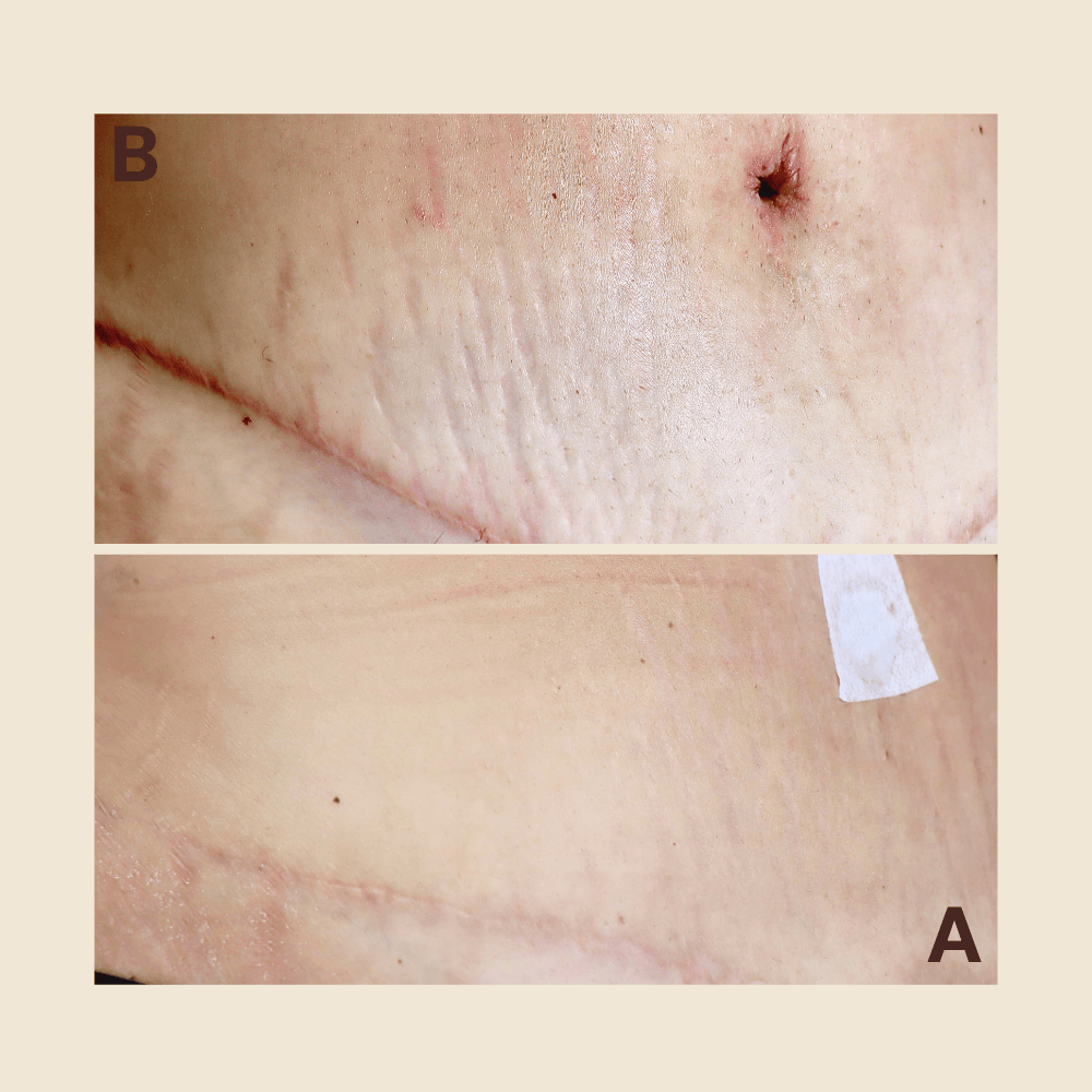 Tattoo Stretch Marks Camouflage