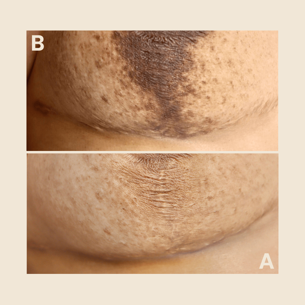 breast scar - Scar Camouflage tattoo