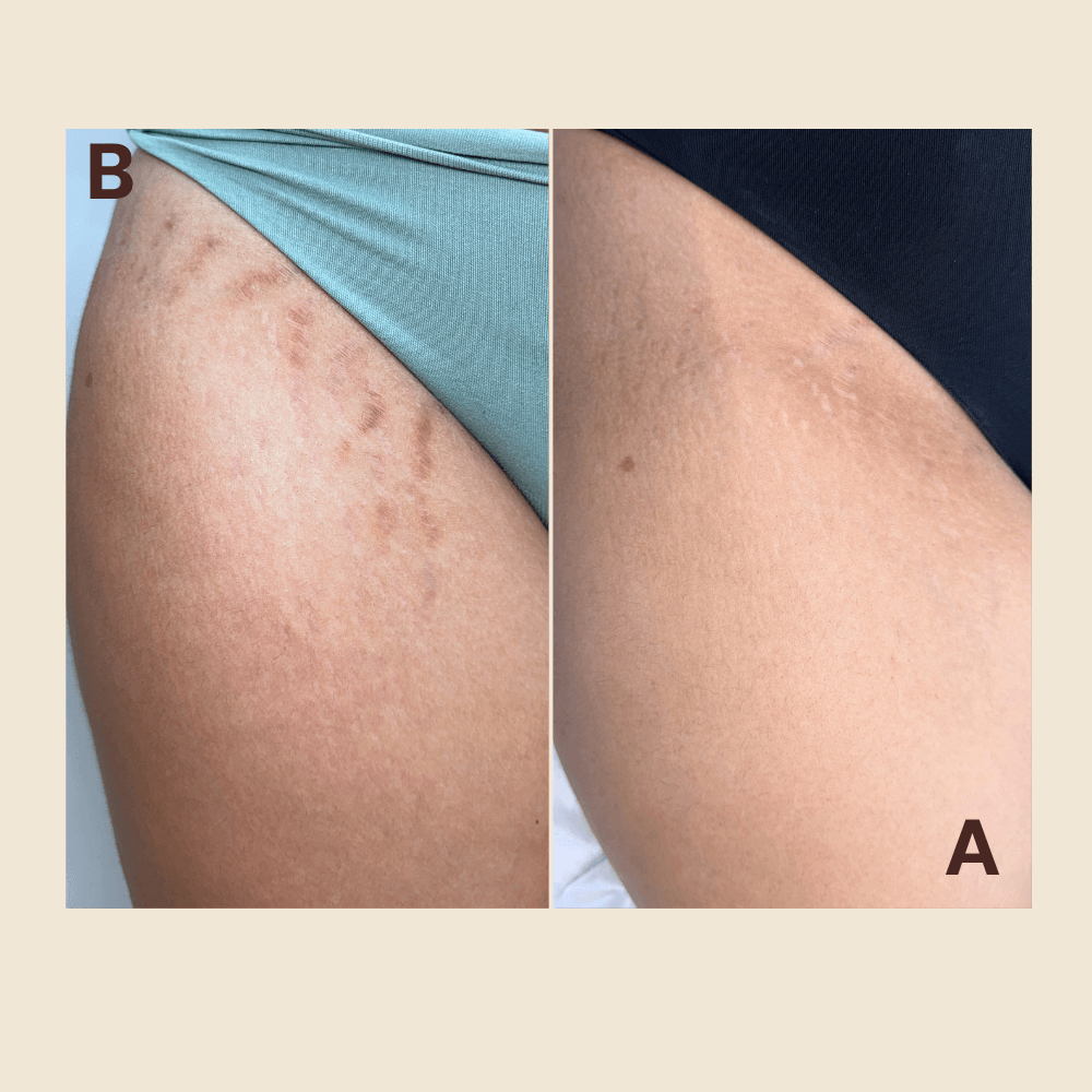 Stretch Marks regeneration camouflage tattoo