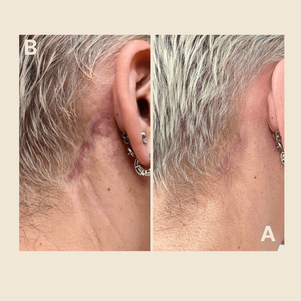 Scar Revision - medical surgery and accidents