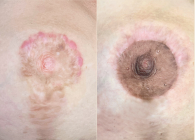 Transforming Breast Scars: My Guide to Areola Revision &amp; Tattoo Camouflage