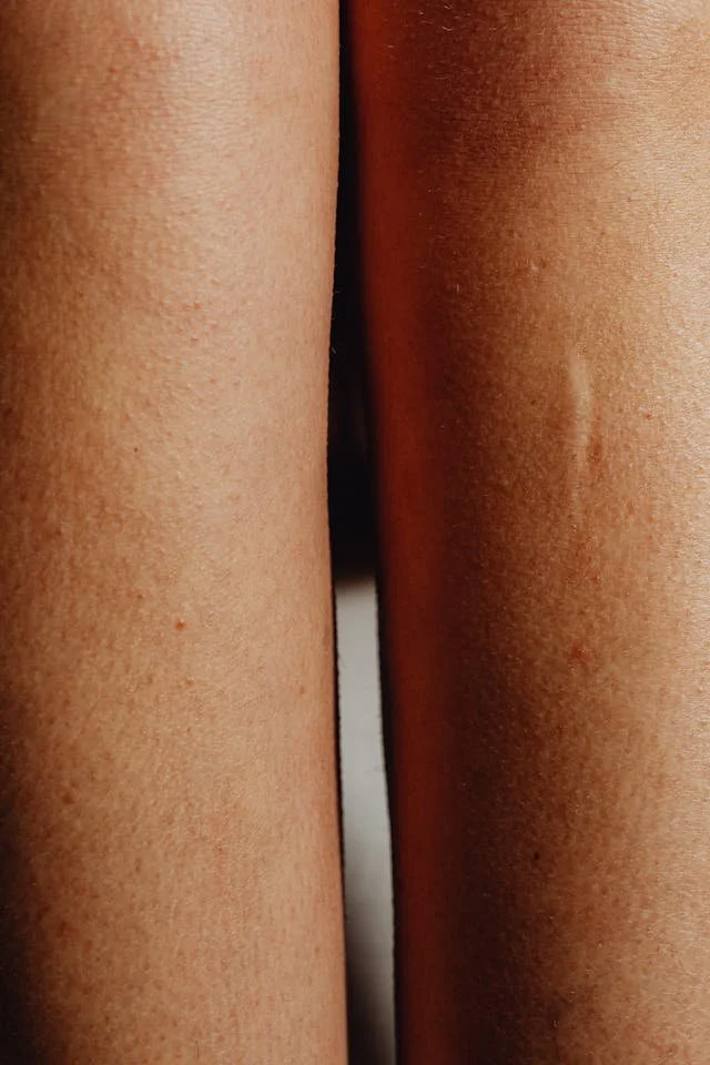 Two Effective Paths to Improve Your Scar: Regeneration or Camouflage