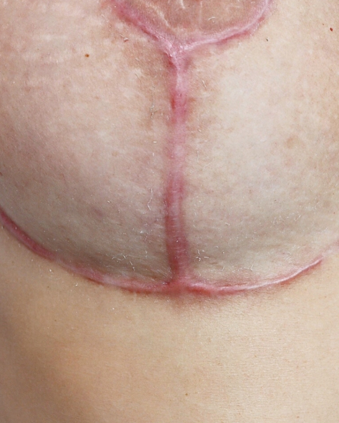 Hypertrophic Scar vs. Keloid: The Expert’s Guide to Identifying Your Scar