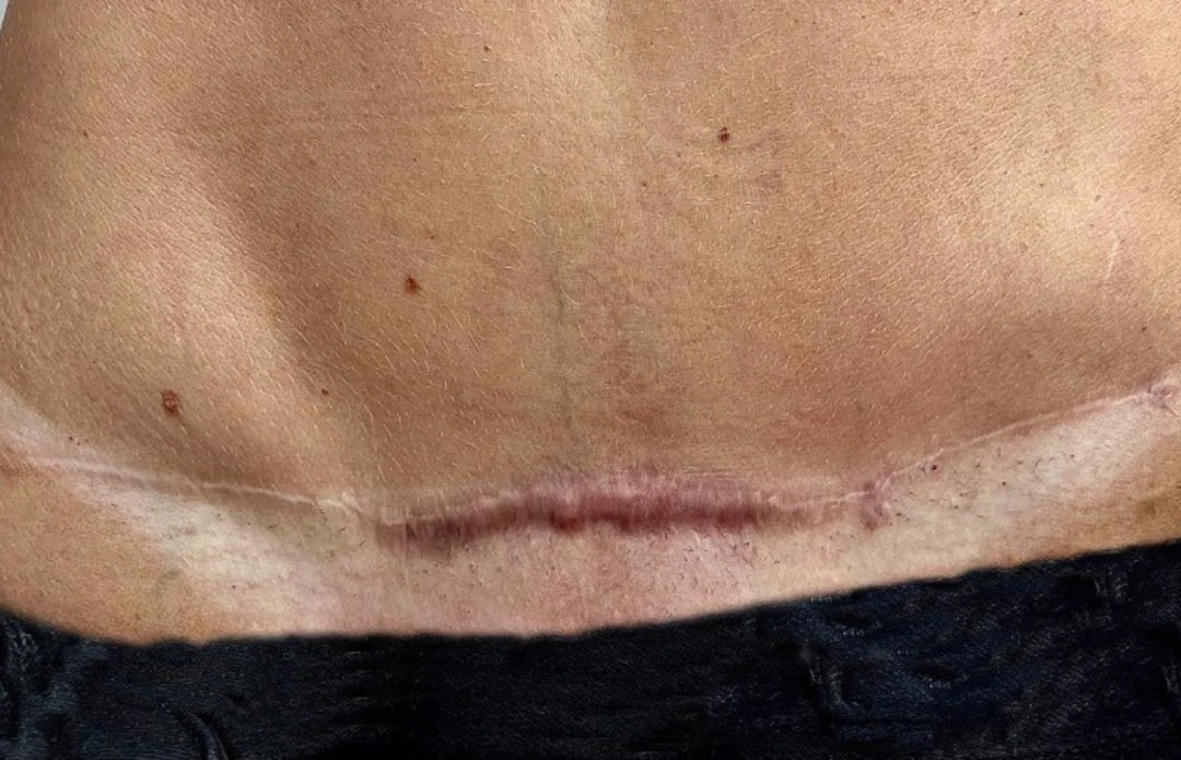 Hypertrophic Scar Healing Stages? Understanding the Journey and How We Can Help