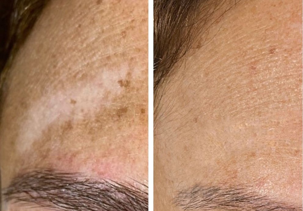 Camouflage Tattoo for Hyperpigmentation: A Scar Transformation Guide