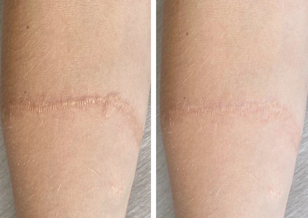 Can a Hypertrophic Scar Go Away? And How We Help at Natalia Mejia Skin