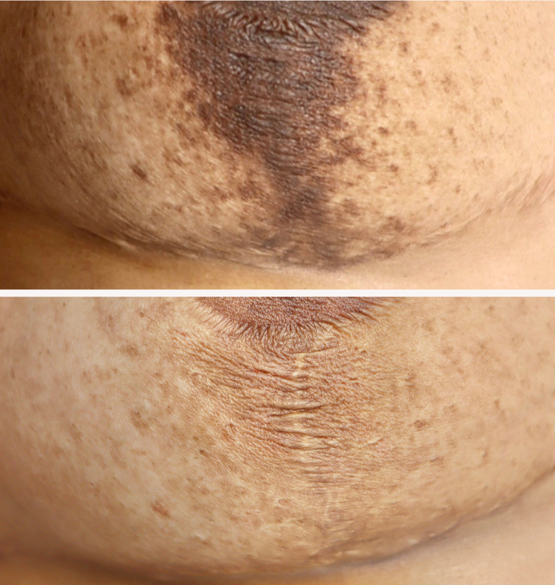 Breast Reduction Scar Tattoo Cover Up: The Complete Guide