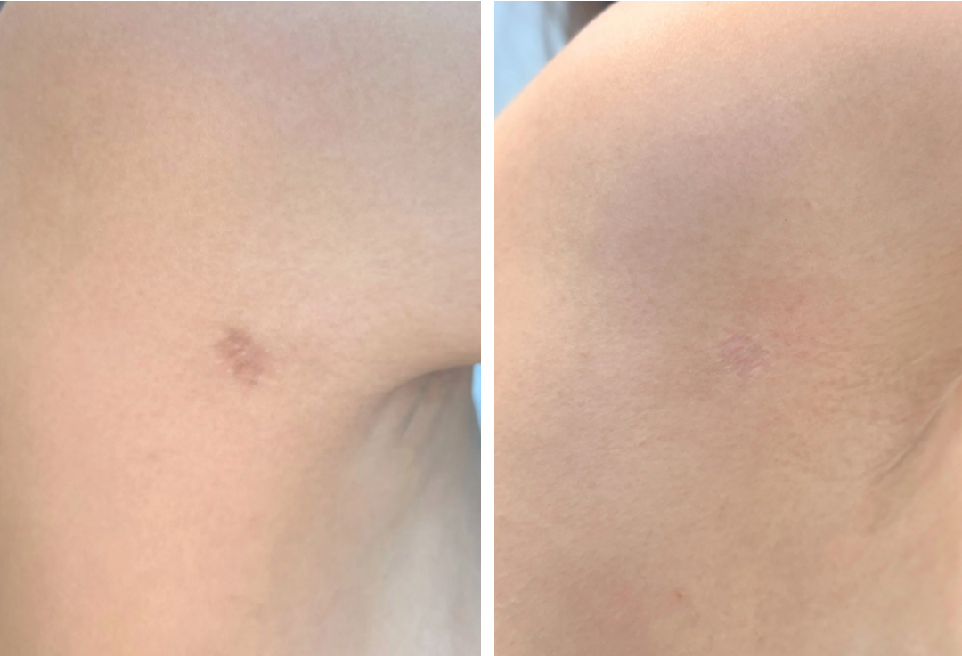 Liposuction Complications: The 5 Most Common After Surgery