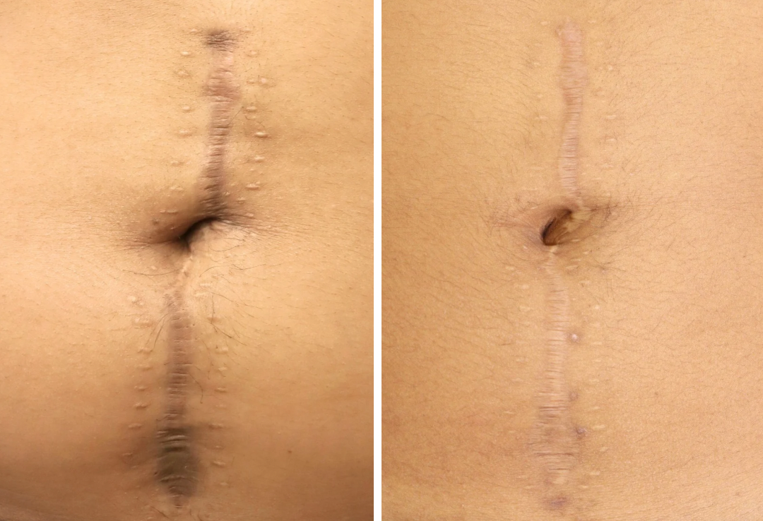 Scar Healing Foods: What to Eat (and Avoid) to Heal Scars Faster