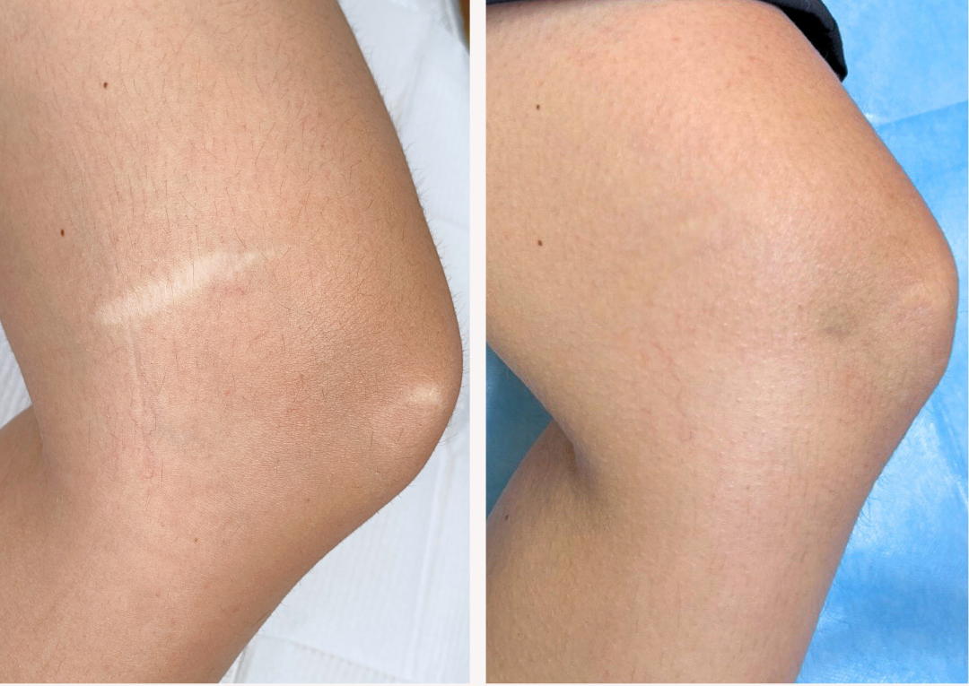 What Is Paramedical Tattooing and How Does It Solve Common Skin Concerns?