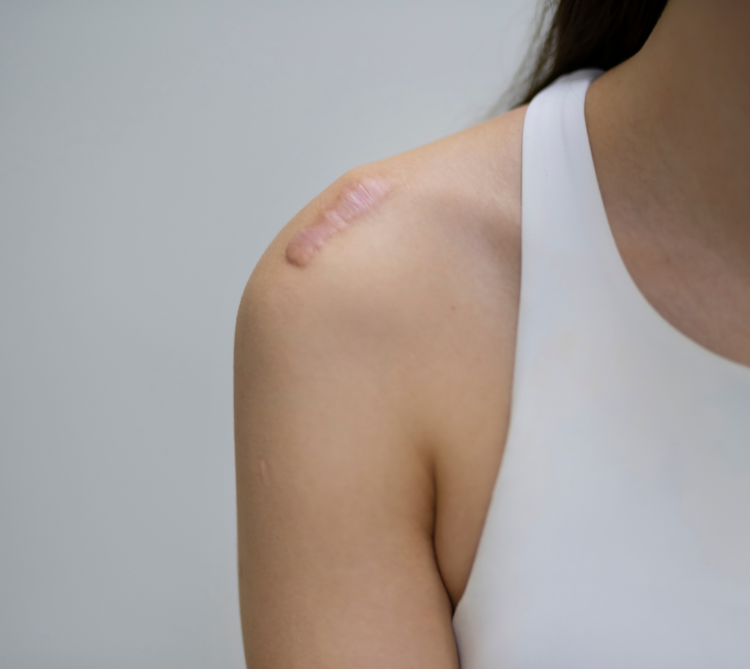 Can I Get a Tattoo with Keloid Skin? Understanding the Risks