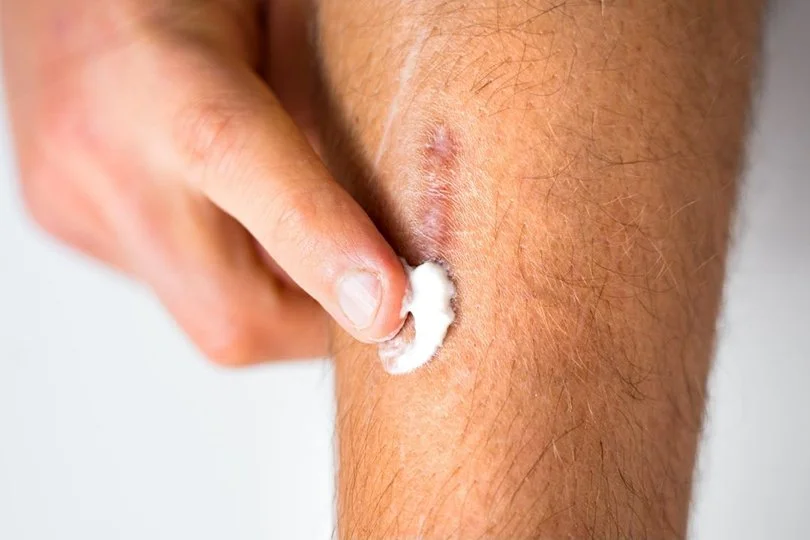 Why Scar Creams Don’t Work on Mature Scars — And What Actually Helps