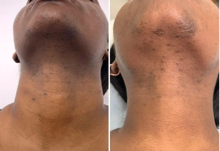 The Natural Peel That Helps Improve Stubborn Dark Spots — Even in Sensitive Areas