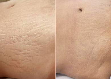 How Stretch Mark Camouflage Works — And Why It’s Not for Everyone