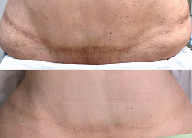 Will My Scar Darken Again After Treatment? What You Need to Know