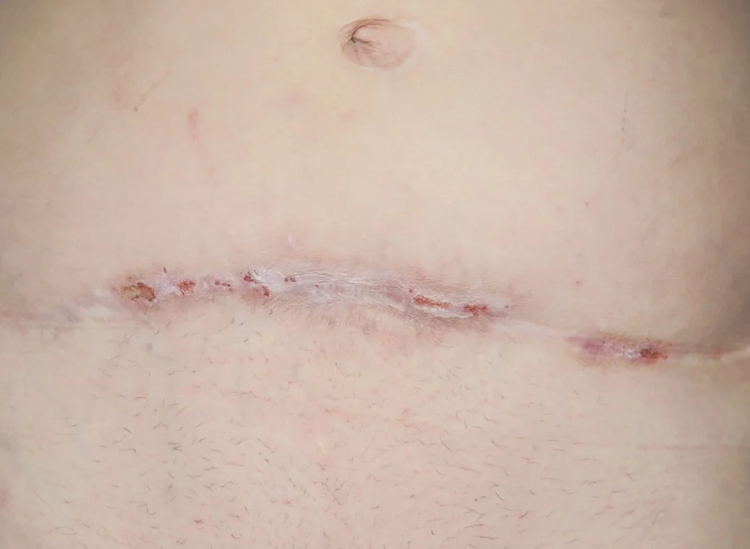 How Tight Clothing and Friction Can Affect Scar Healing