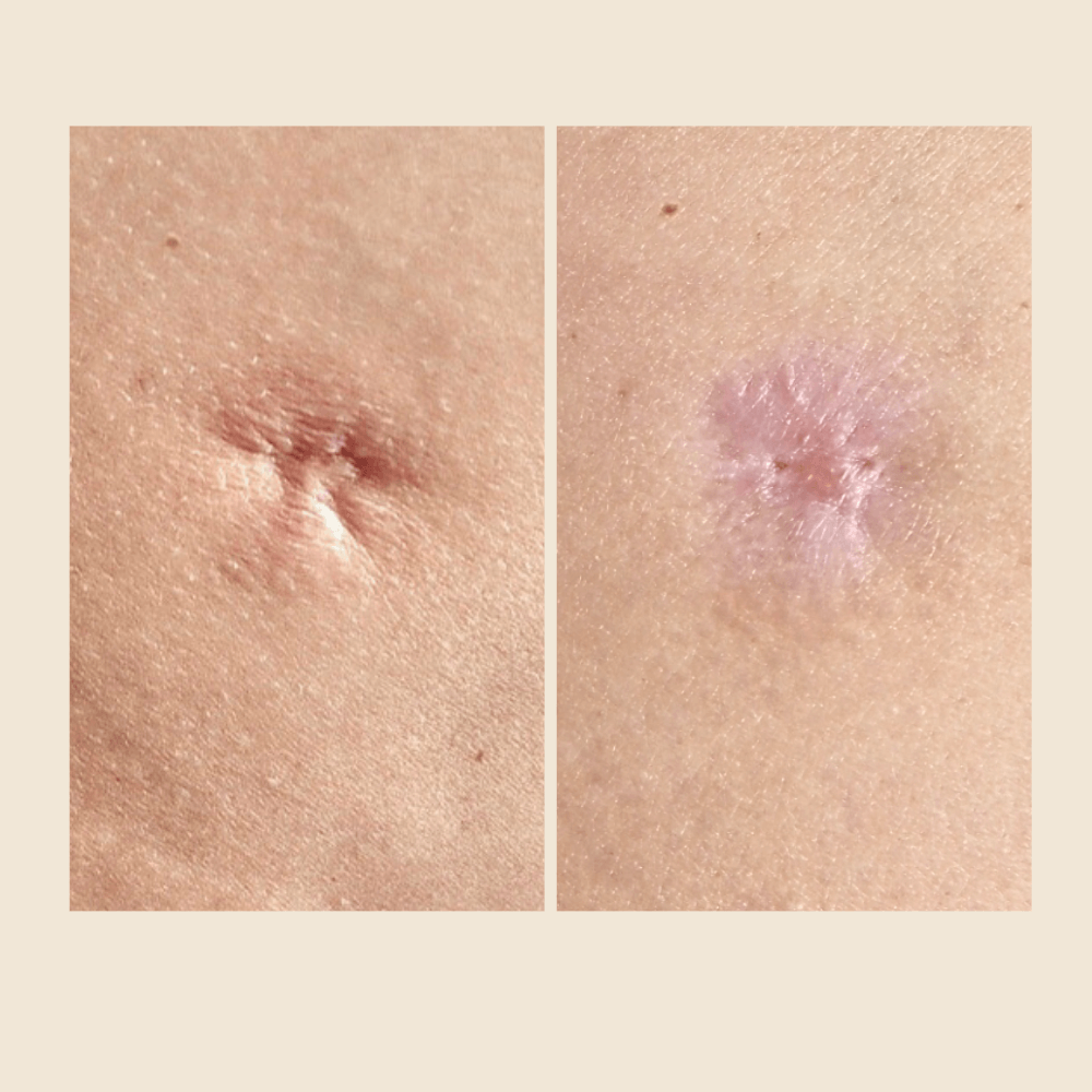 Why Atrophic Scars Don’t Fill in on Their Own (And What Actually Helps)