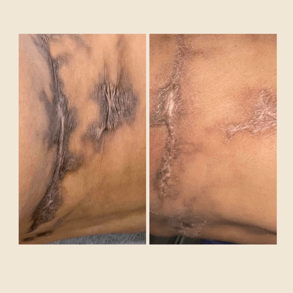 Burn Scar Treatment: Why These Scars Require Specialized Care