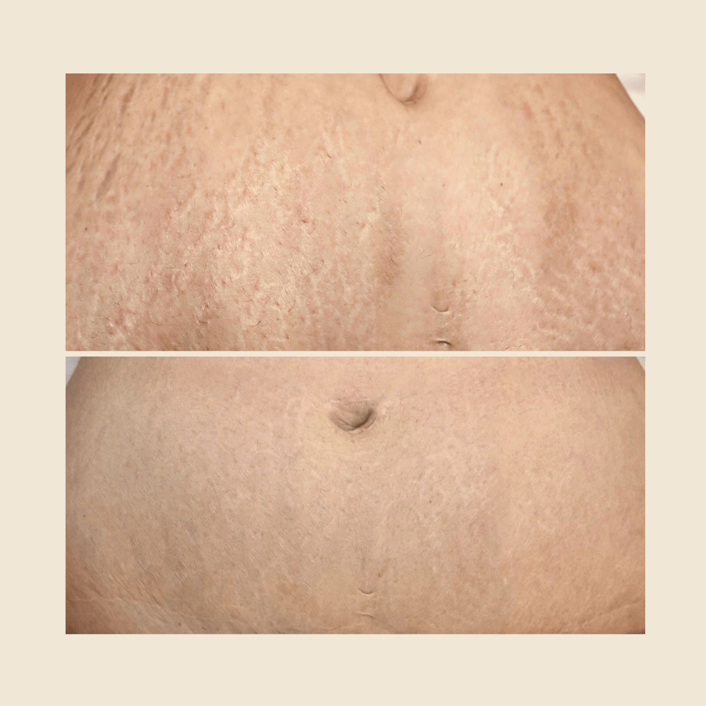 What Types of Stretch Marks Can Improve?