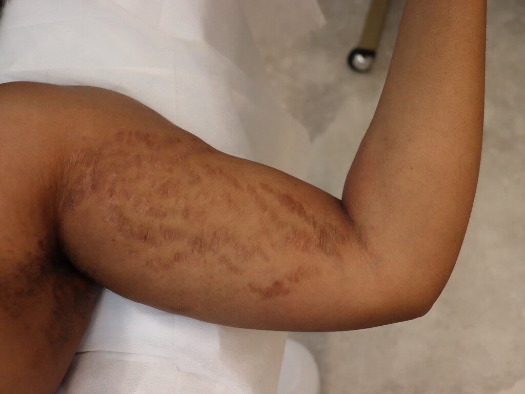 The Hidden Dangers of Unregulated Skin-Lightening Creams: Damage That Can Be Permanent