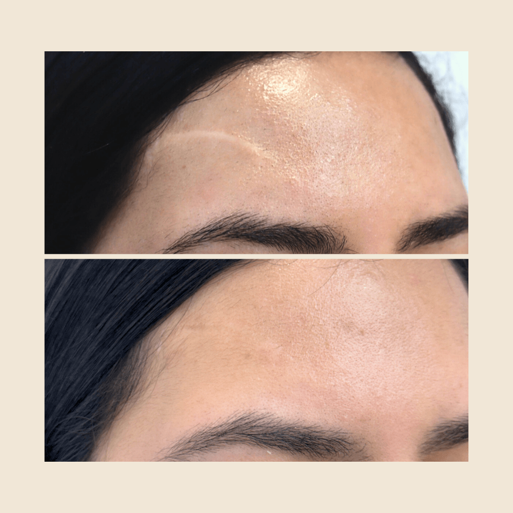 Still Expecting Fast Results for Your Scar? Here’s the Truth About Real Transformation (art 22)