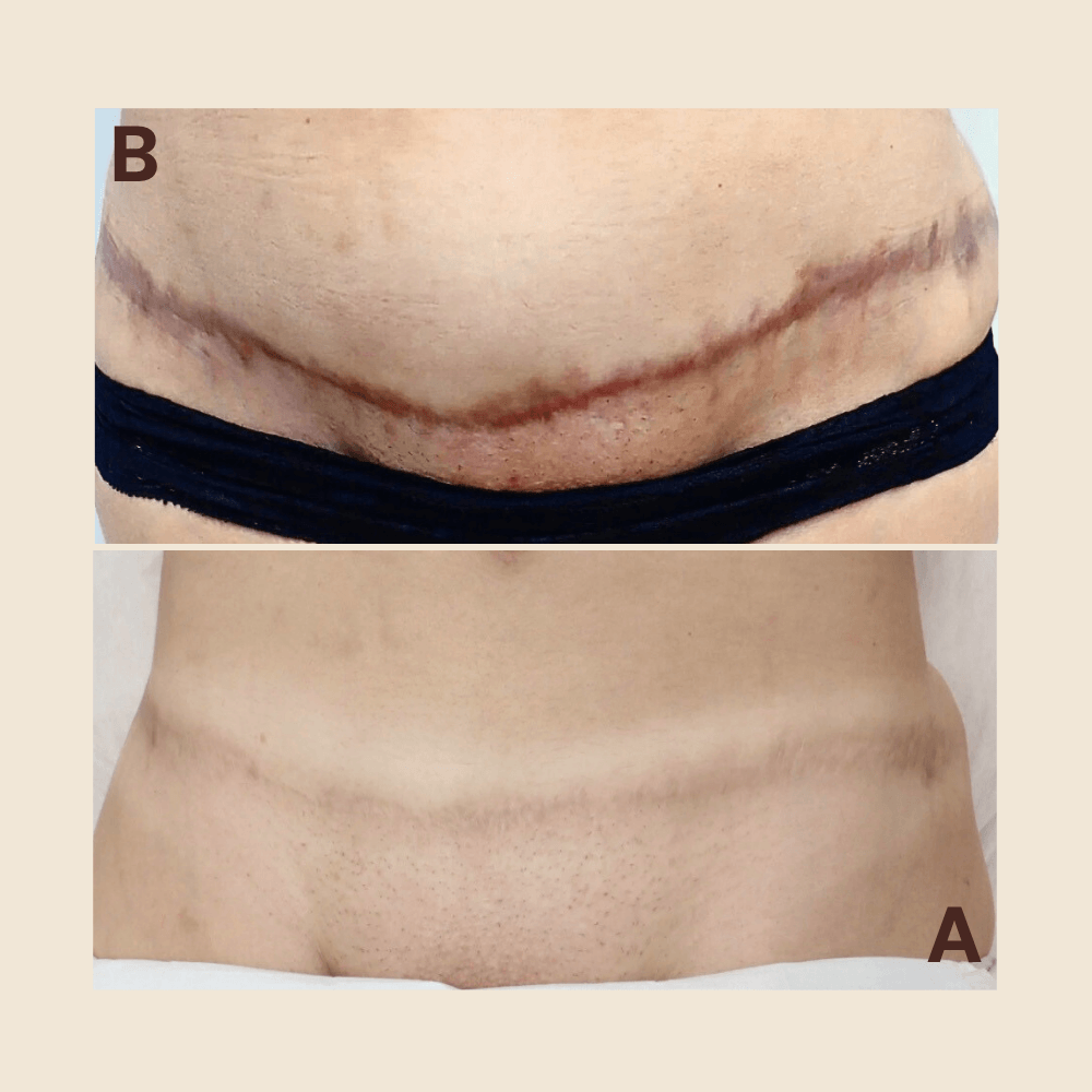 Why Winter Is the Best Time to Start Scar Treatment: From Regeneration to Camouflage — and Summer Confidence