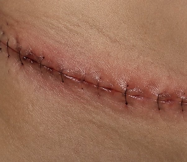 The Most Understated Phase of Scar Healing: Months Three to Six