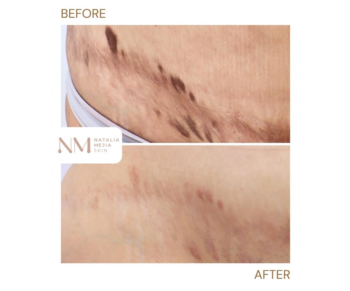 scar-camouflage-tummy-tuck-04.jpg