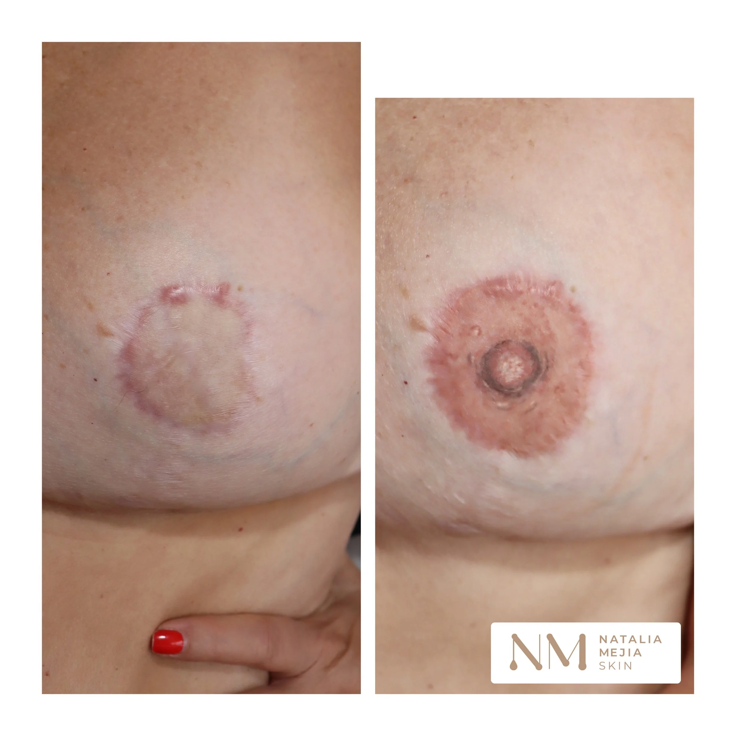 areola reconstruction