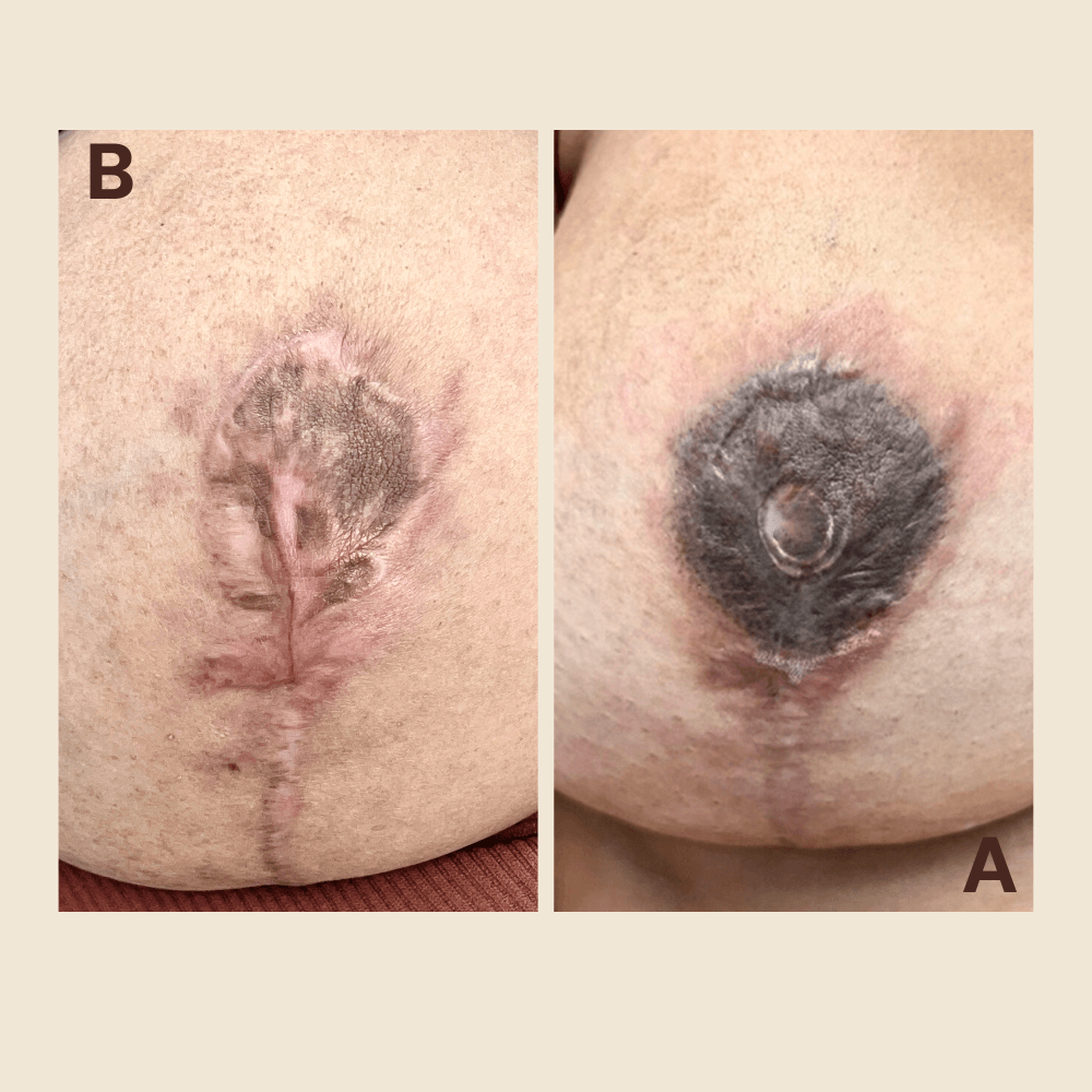 3d Areola restoration tattooing - necrosis