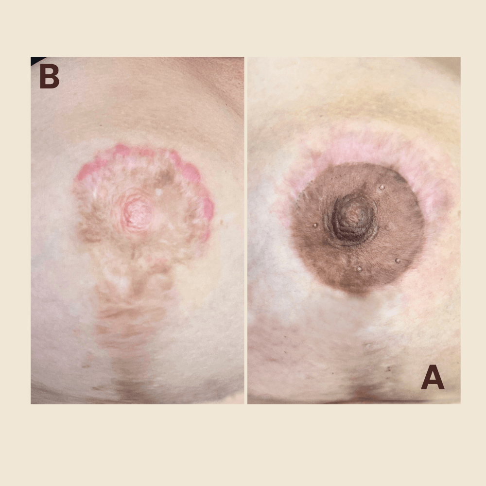 3d Areola restoration tattoo - necrosis