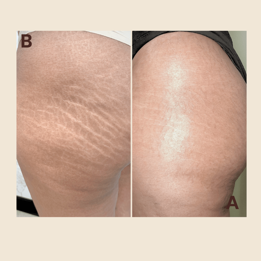 Stretch Marks regeneration