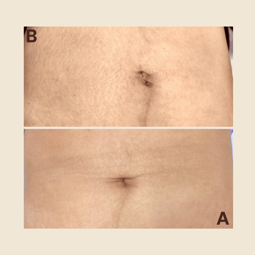 Tattoo Stretch Marks