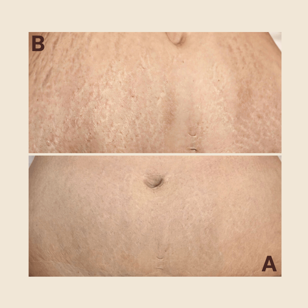 Tattoo Stretch Marks Regeneration