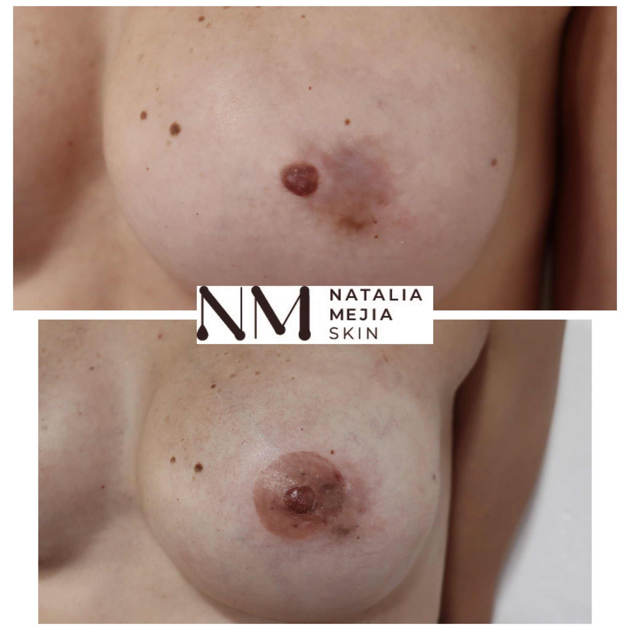 nipple reconstruction before and after