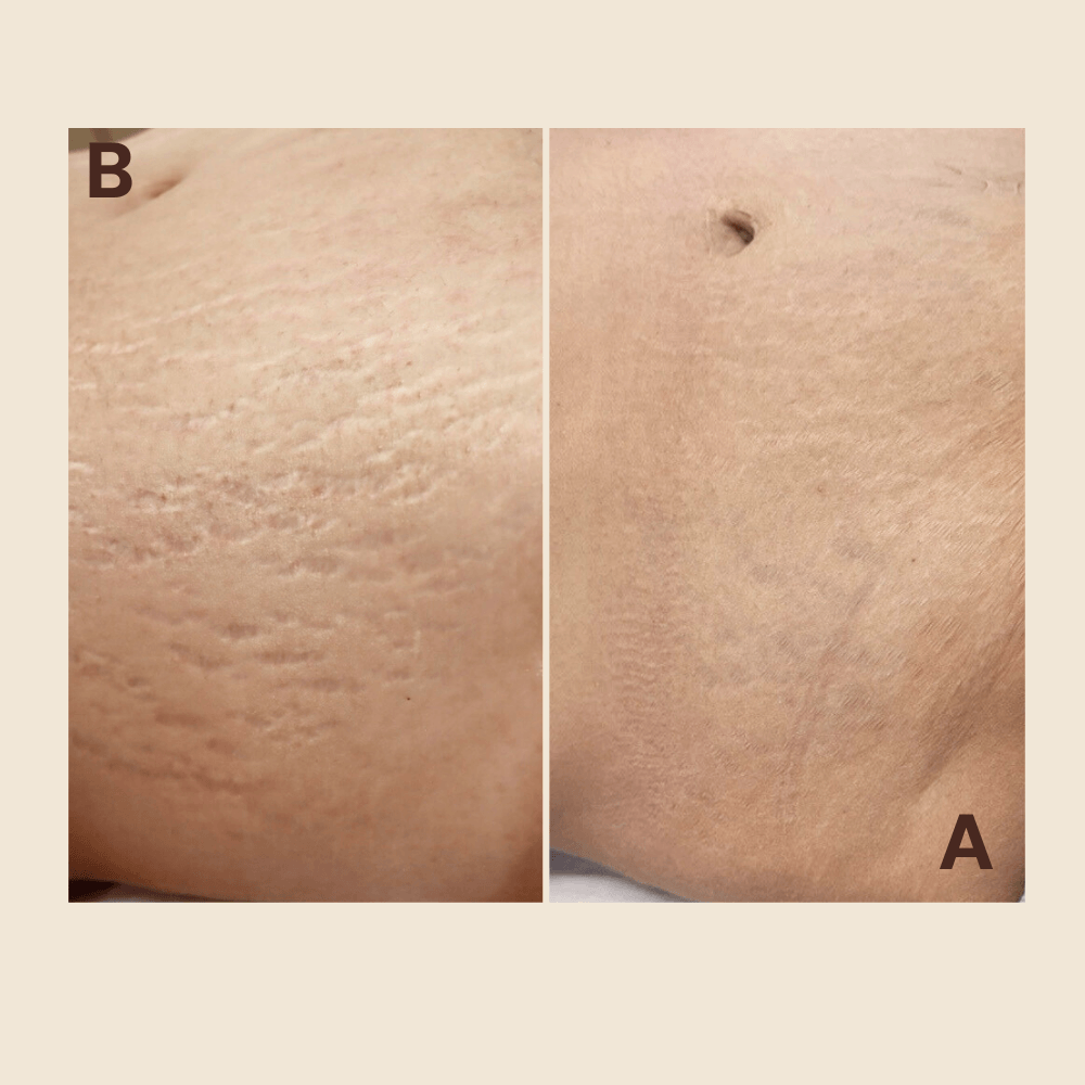 Tattoo Stretch Marks Cover up