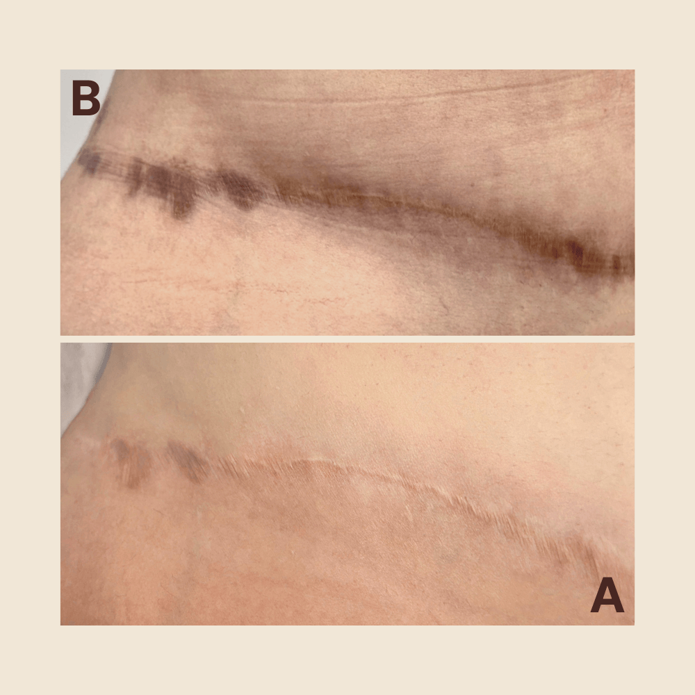 non-surgical-scar-revision.png