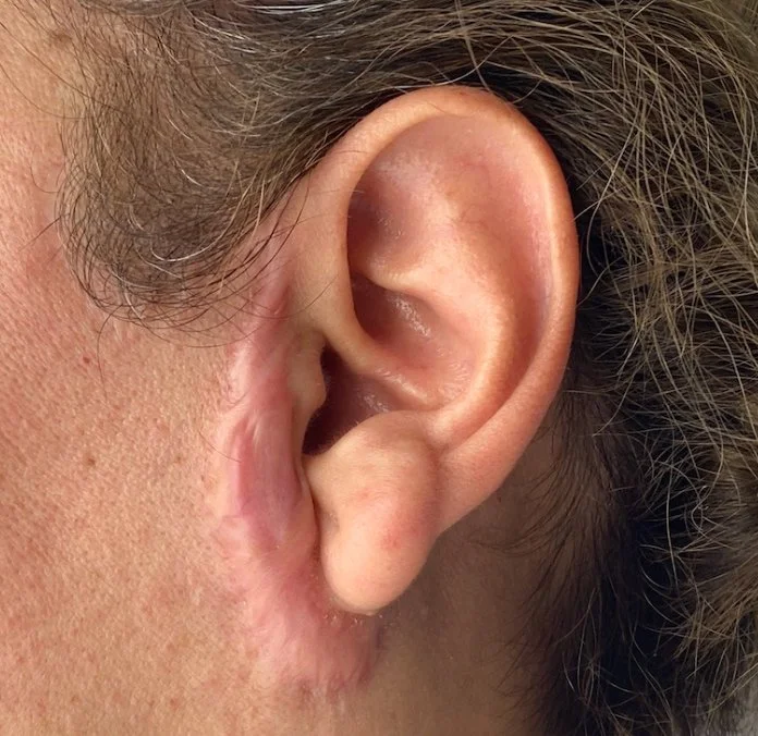 Hypertrophic scar formation